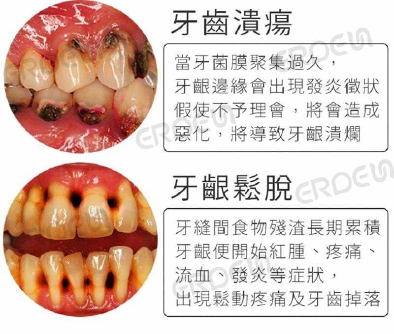 歯ぐきの腫れと緩み